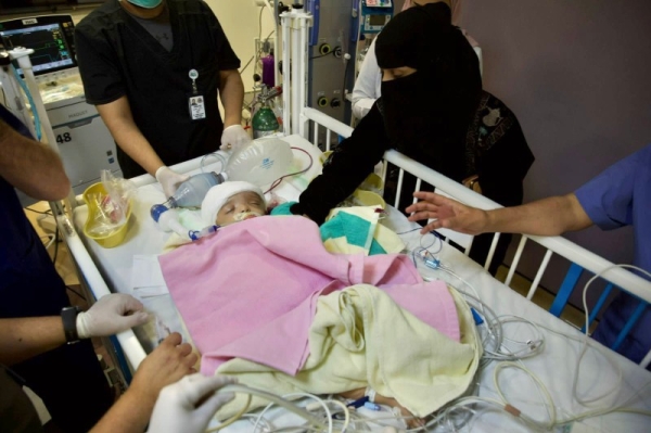 Saudi surgical team announces death of one of the separated Yemeni conjoined twins