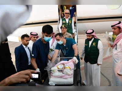 Operation to separate Yemeni conjoined twins Mawaddah, Rahmah set for Thursday