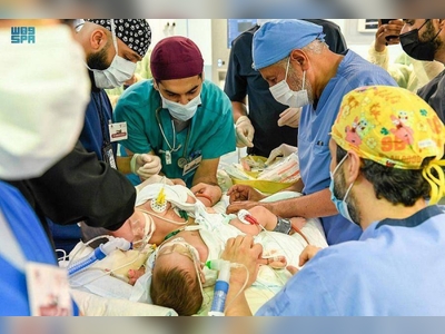 Separation surgery for Yemeni conjoined twins begins in Riyadh