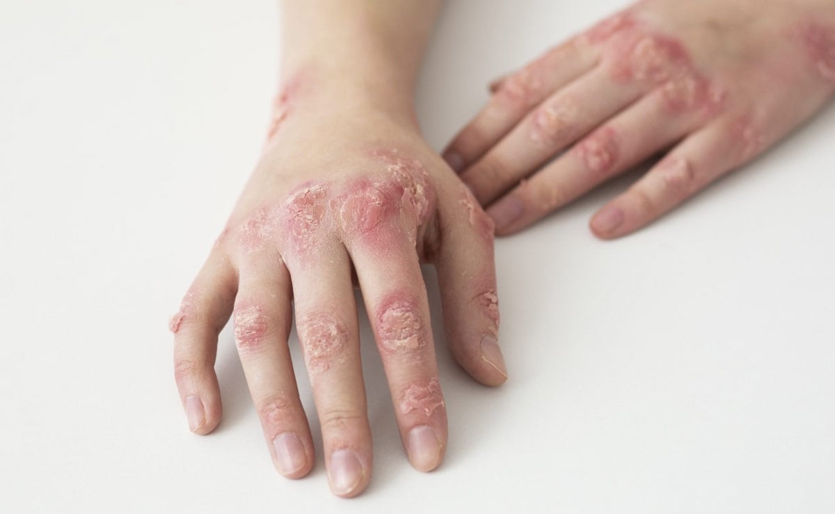 Drug-Resistant Ringworm Detected In US, Says Report