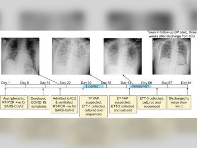 New Study Finds That Secondary Bacterial Pneumonia Is a Major Cause of Death in COVID-19 Patients Who Require Ventilator Assistance